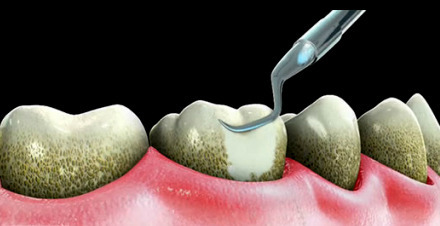 deep cleaning scaling and root planing