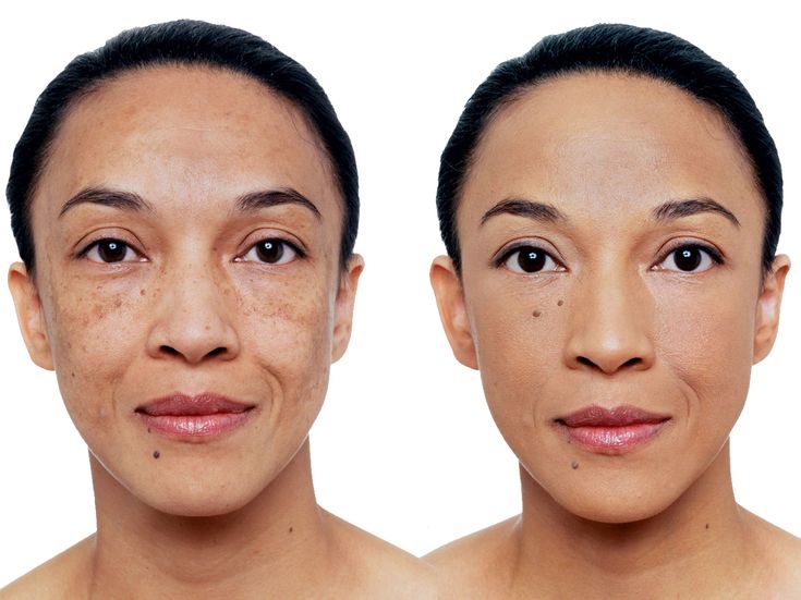 Cosmetic Skin Camouflage